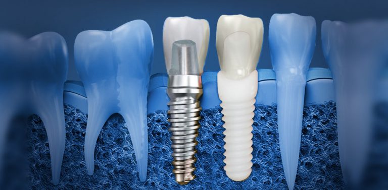 Holistic Dental Alternatives - Competition-New-Dental-Implant-featured-768×377