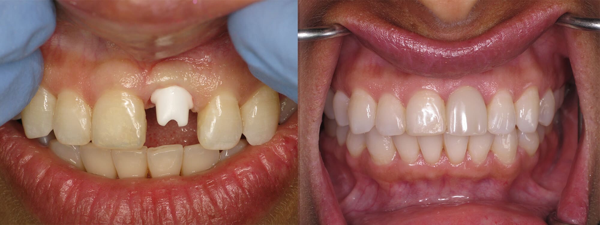 Holistic Dental Alternatives - bp1-hollistic-ceramic-implant