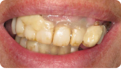 TeethNow Dental Implant Centers - Untitled design (34)