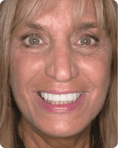 TeethNow Dental Implant Centers - after1