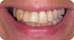 TeethNow Dental Implant Centers - before-1