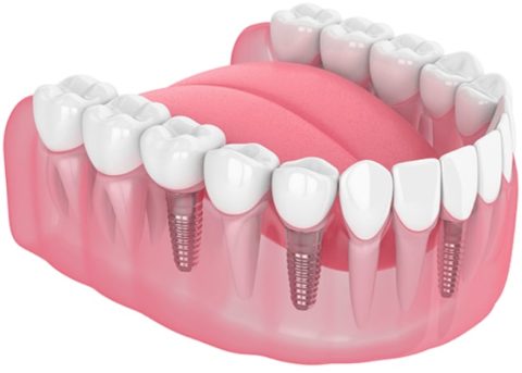 TeethNow Dental Implant Centers - smile-image