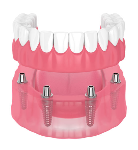 TeethNow Dental Implant Centers - 3d render of removable full implant denture