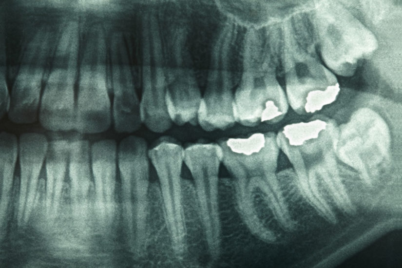 Smile in a Day™ - dental-xray-2-825×550