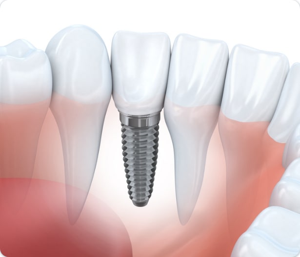 All On 4 Implants - teeth-draw