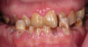 Brian Prutkin's All-On-4 Transformation - before-teeth-bp-300×161