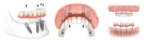 All-On-Four Procedure - dental-implants-all-on-four-midtown-nyc-1-300×83