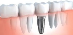 Smile In a Day - Same Day Dental Implant Treatment - download-300×143