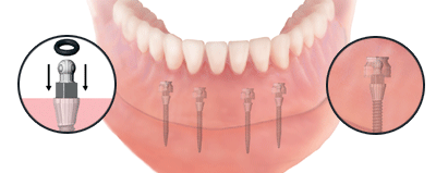 Mini Dental Implants - mini-dental-implants-1