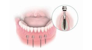Mini Dental Implants - mini-implants-for-denture-300×164