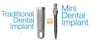 Mini Dental Implants - mini-vs.-traditional