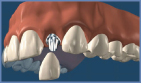 Smile In a Day - Same Day Dental Implant Treatment - siad1-2