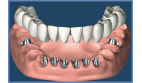 Smile In a Day - Same Day Dental Implant Treatment - siad2